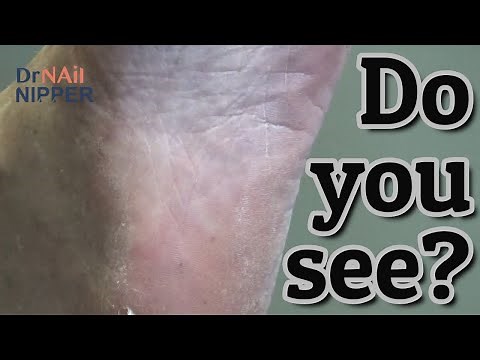 Splinter in the Heel. Who removes splinters? Dr Nail Nipper (2021)