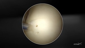 Osteochondral Flap Repair System With Chondral Dart™ Implant