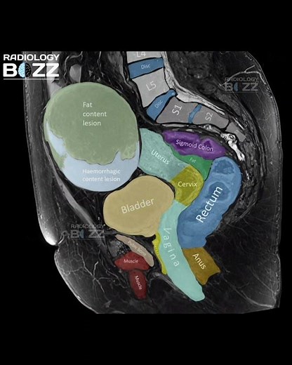 MRI Pelvis | Complex Pelvic Mass – Teaching Case