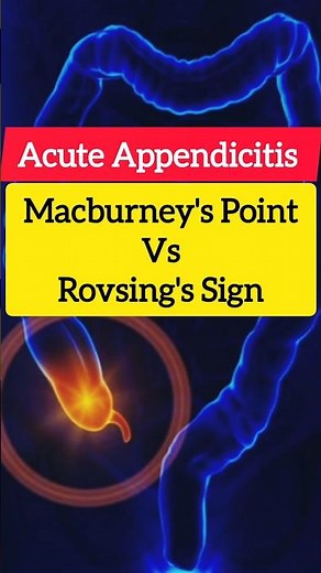 Mcburney's Point vs rovsing's Sign in acute appendicitis #surgery