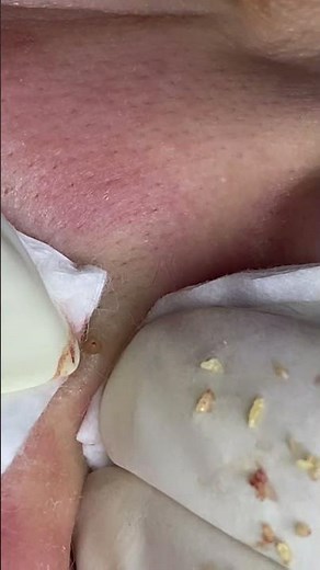 Big Cystic Acne Blackheads Extraction Blackheads & Milia, Whiteheads Removal Pimple Popping #shorts