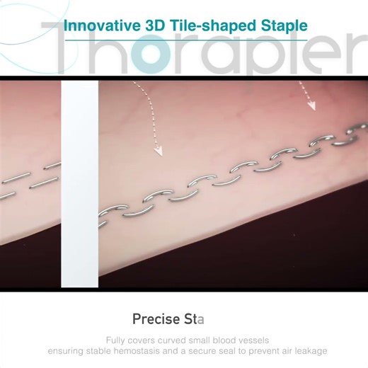 Fulbright Thorapler—3D Tile shaped Staple