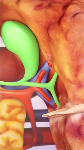 liver transplant surgery procedure #animation #medical #surgery
