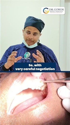Immediate implant placement after molar removal #dentist #shorts