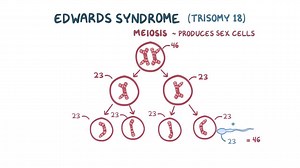 Video: Edwards syndrome (Trisomy 18) - Video Explanation! | Osmosis | Osmosis