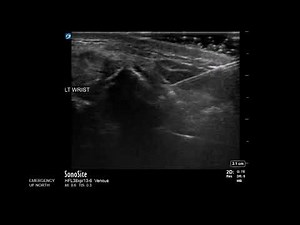 Wrist Ultrasound: Distal Radius Fracture Hematoma Block