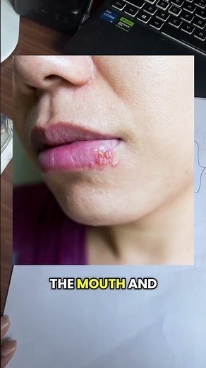 Herpes simplex treatment