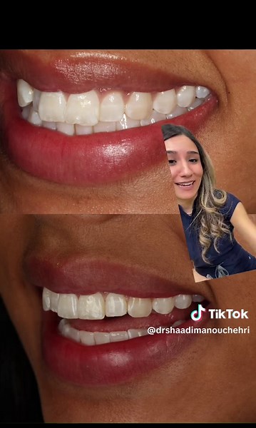 Transform Your Smile with London Invisalign