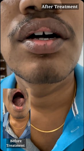 #TARDIVE dyskinesia | SP HOMOEO CARE