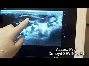 Varicocele Doppler Ultrasound Must Be Done in Standing Up Position - Cuneyd SEVINC, MD