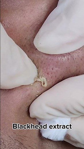 Blackhead Extraction at HHV Clinic | Do Thu Hien | Hien Van Spa