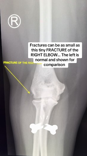 Understanding Tiny Fractures in the Right Elbow