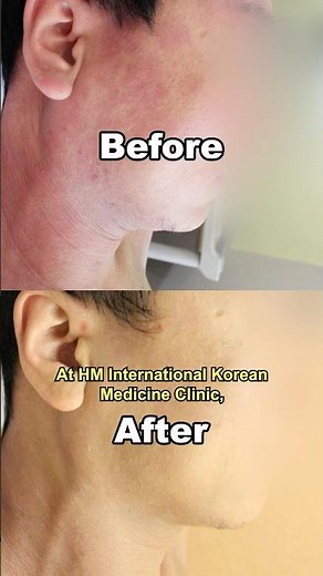 Real Atopy Healing: Before & After (No Steroids)