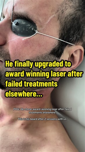 Transform Your Grooming with Award-Winning Laser Hair Removal