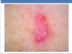 Dermoscopy (basal cell carcinoma): Dr. Rania Alakad