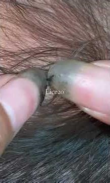 (Part 236) Removing Lice by Hand Satisfying Lice #lice #liceremoval #shortsfeed #shorts #shortsviral