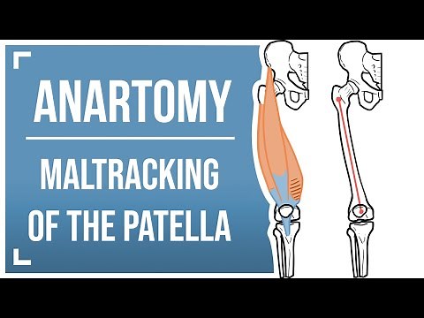 Maltracking of the Patella