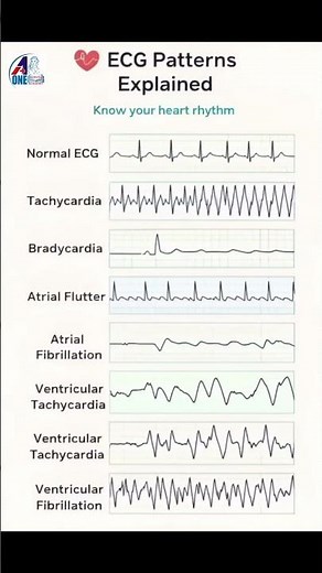 Normal vs Abnormal ECG Rhythms Explained Fast #cardiology #nursing #shorts #tips #medico