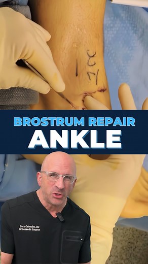 Cory Calendine MD on Instagram: "Chronically Ankle Instability? . The Brostrom procedure is a surgical option designed to restore wobbly, unreliable ankles back to rock-solid foundations. This gold-standard ankle repair is like precision tailoring for your ligaments. When you repeatedly sprain your ankle, the lateral ligaments on the outside become stretched and loose, similar to worn-out rubber bands that have lost their snap. The most commonly affected is the anterior talofibular ligament, whi