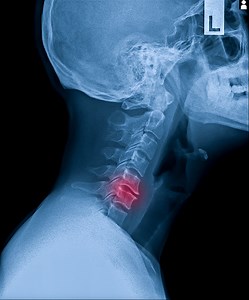 X-ray of neck and cervical spine side view. Image of radiography from...