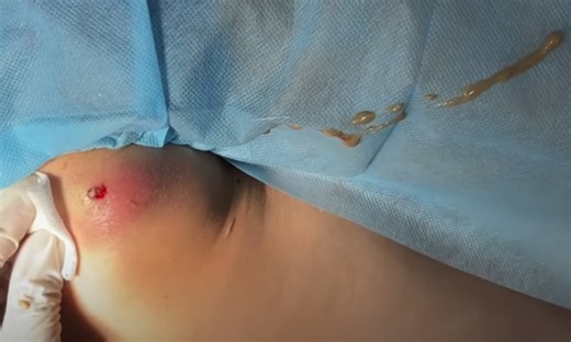 Stubborn Sebaceous Cyst Explodes When Squeezed