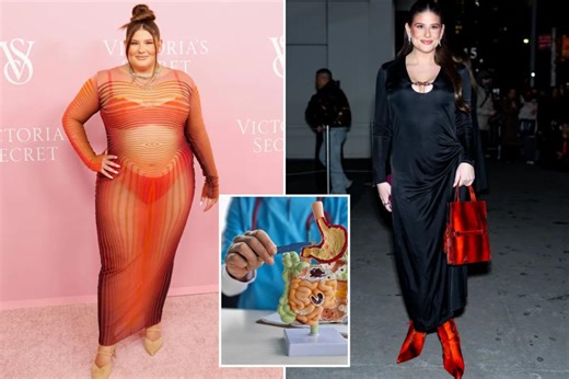 What is SADI-S? New surgery leads to more weight loss than gastric bypass and Ozempic