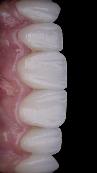 Emax Veneers for a Natural Smile Transformation
