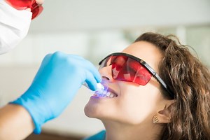 Professional Teeth Whitening - Step-by-Step Guide by a Dentist | My Local Dentists Seven Hills