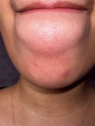 Effective Pore Cleansing Techniques for Large Pores