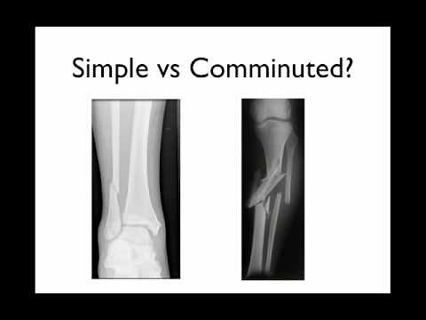 How to describe a fracture