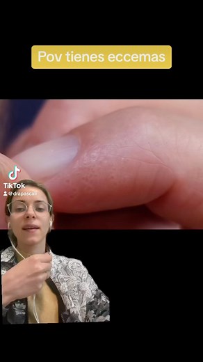 152K views · 10K reactions | Acá un video completo de que hacer y qué evitar en caso de tener eccemas. . . . . #drapascali #eccemaseborreico #eczema #eccem | Dra. Daniela Pascali - Dermatología & Medicina Estética | Facebook