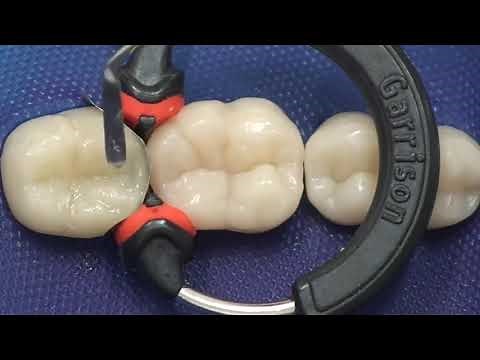 3M ESPE Filtek - Composite Restoration using Bulk Fill Technique PinkBlue.in