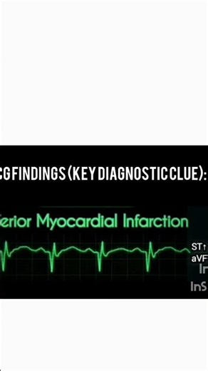 ECG (EKG) Waveform Interpretation Explained#shorts#ecg#angina#myocardialinfarction#heartattack#heart