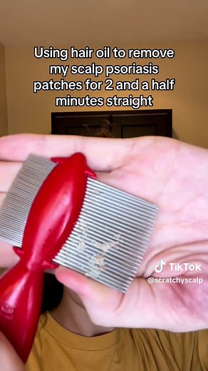 Removing Scalp Psoriasis Patches with Fluocinolone Acetonide | Satisfying Removal