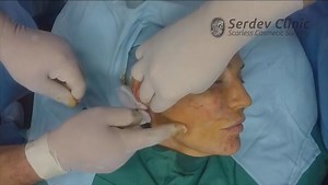 Watch Lower Face & Neck Lift via Serdev Suture® method. Surgical video. Online | Vimeo On Demand