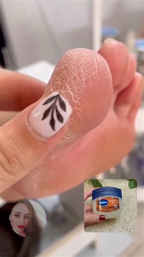 The strongest recipe to moisturize your feet and heal cracks fast" #FootCare #CrackedHeels #BeautyTips #HomeRemedies #Skincare | إنتصار عبد الرازق