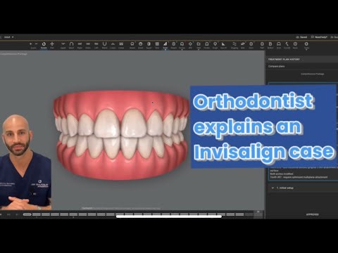 Orthodontist who treated himself w/ Invisalign reviews an Invisalign case that relapsed after braces