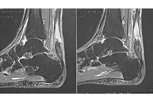 Rupture du tendon d'Achille : opération et rééducation - Dr Elkaïm