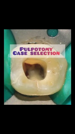 Dr Amritha MDS on Instagram: "Case selection criteria for full pulpotomy 🦷 #pulpotomy #endodontics #dentalstudents #dentalhealth #dentalcare #dentistsofinstagram #dentistsofindia #dentistryworld #dentalreels"