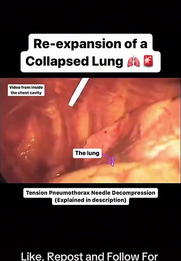 Tension Pneumothorax: Life-Saving Needle Decompression