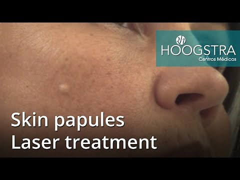Skin papules - Laser treatment (21023)