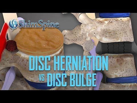 Disc Herniation vs Disc Bulge