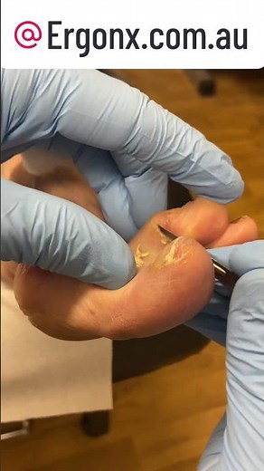 Satisfying Corn Removal: Podiatrist Cuts Corns Between Toes #FootCare #Podiatry