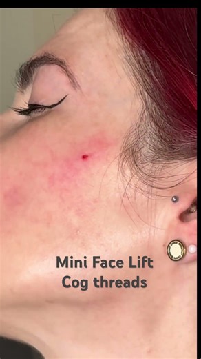 Laura’s Mini Face Lift with Cog PDO threads