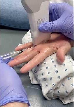 Set up for ultrasound guided trigger finger injection