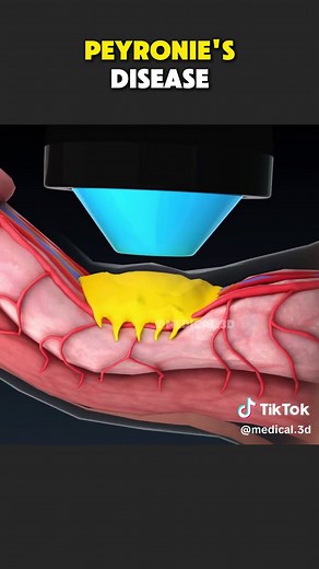 Understanding Peyronie’s Disease and Treatment Options