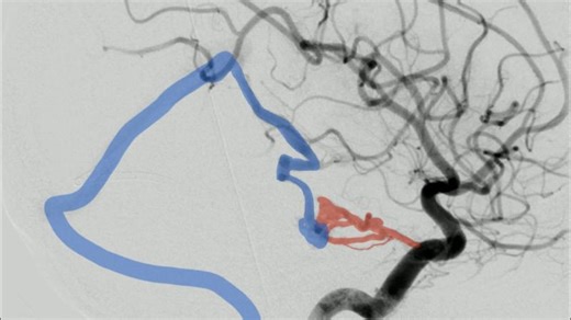 (English) Transvenous Pressure Cooker Technique in Bernasconi–Cassinari DAVF | Mohammad Almohammad
