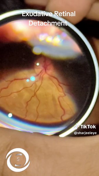 #sharjeeleye #sharjeelkhanblach #eye #retina #retinaldetachment #exudativeretinaldetachment #serousretinaldetachment #vogtkoyanagiharada