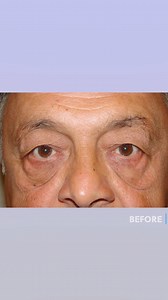 14 reactions | This great patient had an upper and lower blepharoplasty and direct excision of festoons. A festoon is an overhanging wedge of skin where the eyelid meets the cheek. For more information on festoon excision, please click link on bio #drmassry #eyesbymassry #massryeyes #lidlift #eyelidexpert#festoons#beverlyhills#facetransformation#blepharoplastysurgery | Dr. Guy Massry, MD | Facebook