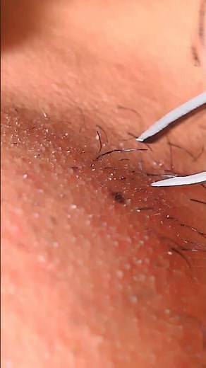 Hair Removal with Finesse The Beard Plucking Method14